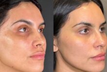 hydrafacial before and after