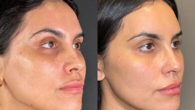 hydrafacial before and after
