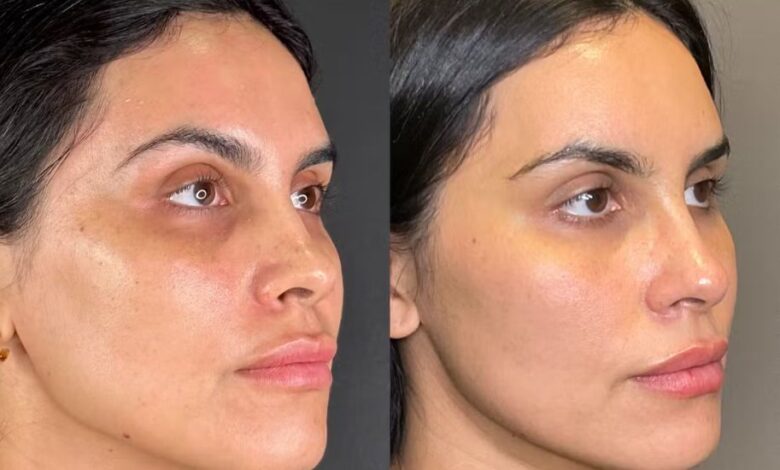 hydrafacial before and after